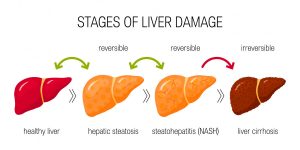 Stages of liver disease diagram