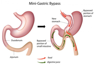 One-Anastomosis Gastric Bypass (OAGB) – ‘Mini’ Gastric Bypass