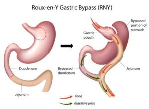 Roux En-Y Gastric Bypass (RYGB) - Gastric Bypass