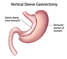 Sleeve gastrectomy (SG)