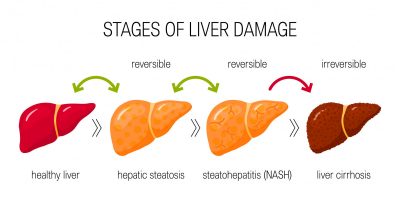 Liver Disease and diet - A guide for adult patients, their carers and ...