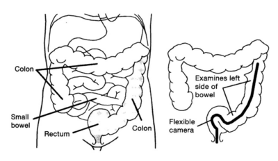 Having a Flexible Sigmoidoscopy (Inpatients) - Bedfordshire Hospitals ...