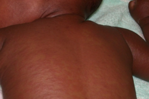 Measles on brown skin