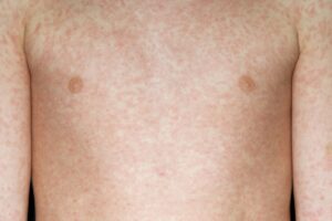 Measles on white skin