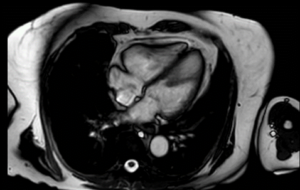 A cardiac scan using an MRI machine