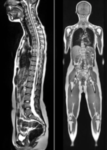 A whole body scan using an MRI machine