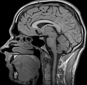 Scan of a brain using an MRI machine