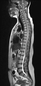 Scan of a spine using an MRI machine