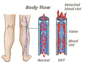 Diagram showing a normal blood flow in comparison to DVT bloodflow