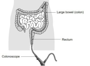 Diagram showing the position of large bowel, rectum and colonoscope