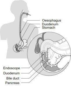 Diagram showing Oesophagus and ERCP procedure