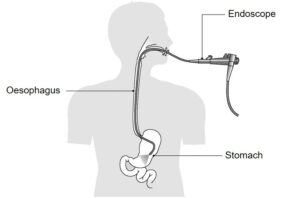 Diagram showing an oesophagus, stomach and the endoscope during procedure