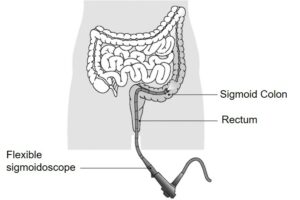 Diagram showing colon, rectum and the insertion of a flexible sigmoidoscope