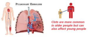 Diagram showing what a pulmonary embolism looks like in the lung